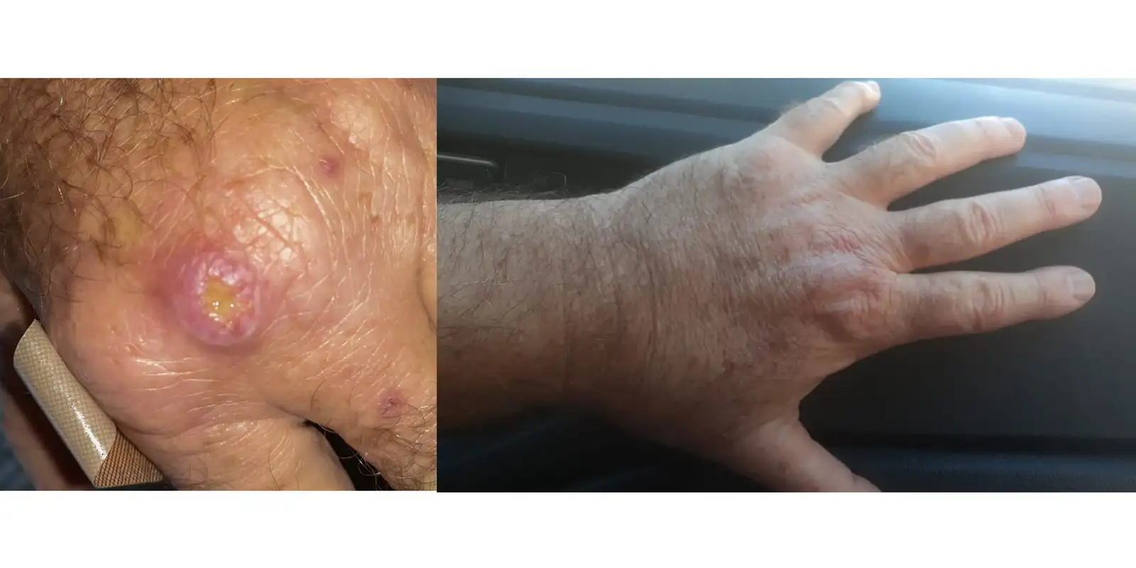 Especialistas alertam para a falta de informação sobre a leishmaniose