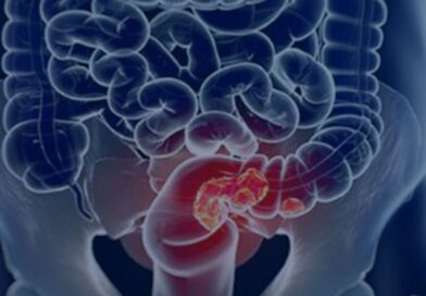 Estudo projeta aumento de 36% em mortes por câncer colorretal até 2040