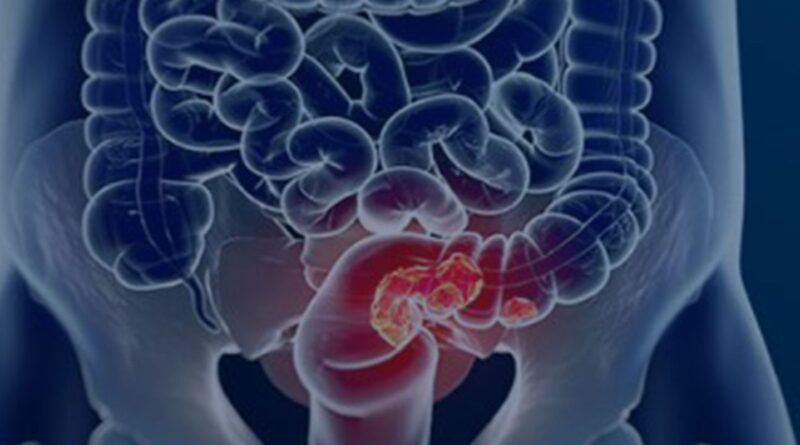 Estudo projeta aumento de 36% em mortes por câncer colorretal até 2040