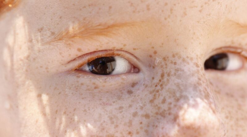 Reflexo branco nos olhos: entenda condição que assusta pais