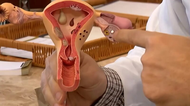 Aberta chamada pública para pesquisas sobre endometriose