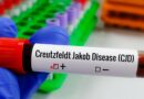 Entenda Doença de Creutzfeldt-Jakob e busca por tratamento